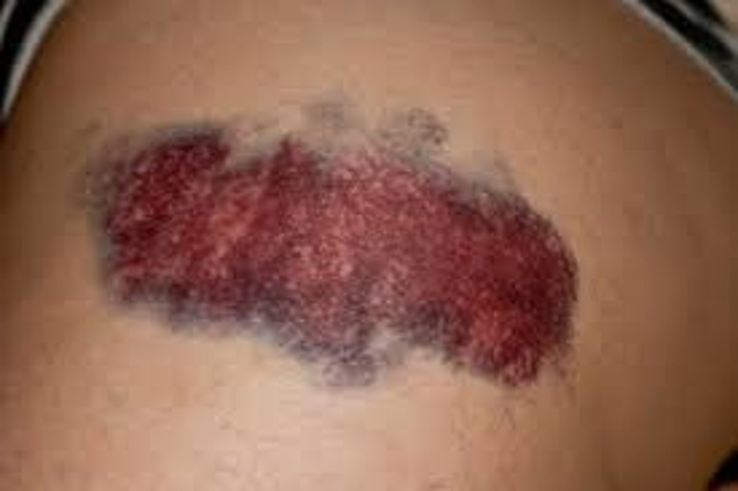 <p>-Bruising or discoloration of the skin or mucous membranes</p><p>-This is when blood seeps into tissues</p><p>Causes:</p><p>-Trauma</p><p>-Abuse</p><p>-Herpin injections (especially umbilicus area)</p>