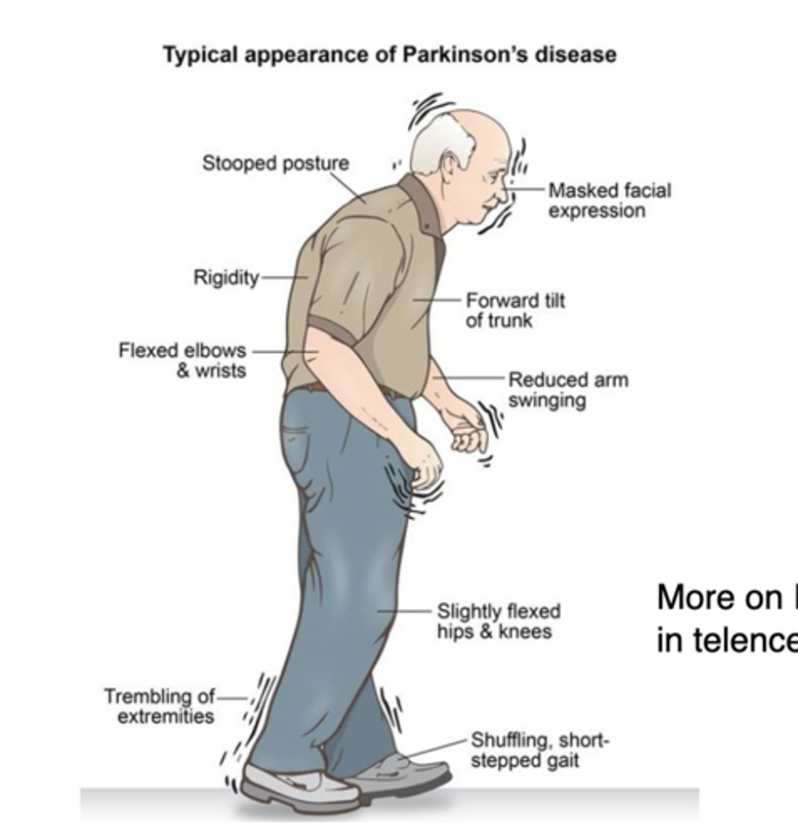 <p>1) Resting tremor</p><p>2) Rigidity</p><p>3) Bradykinesia</p>
