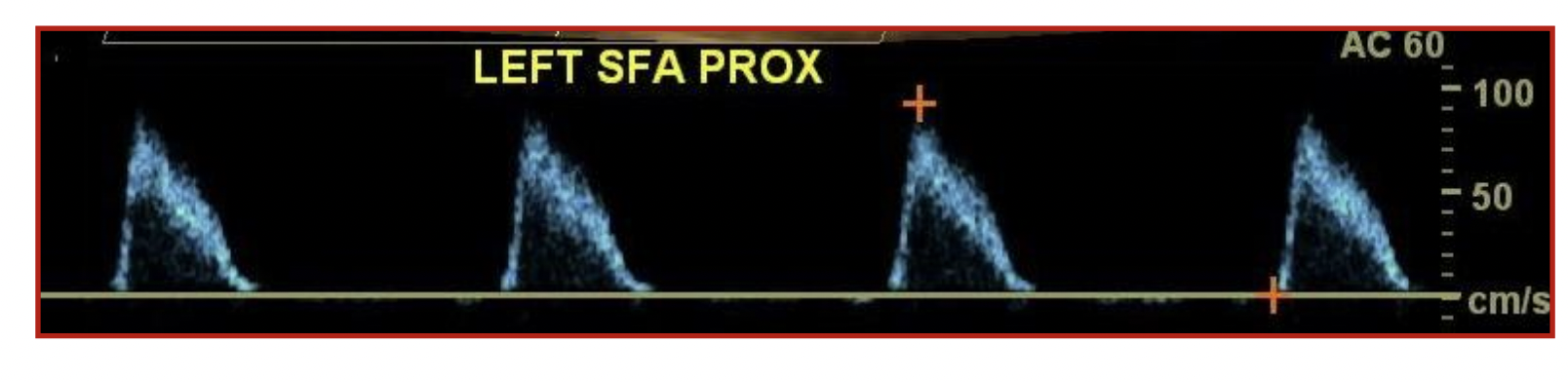 <p>Resting superficial femoral artery waveforms from a 78 y.o. diabetic patient, what can you tell from it?</p>