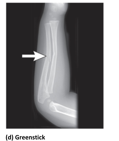 <p>a partial fracture</p><ul><li><p>mostly seen only in young children</p></li></ul><p></p>