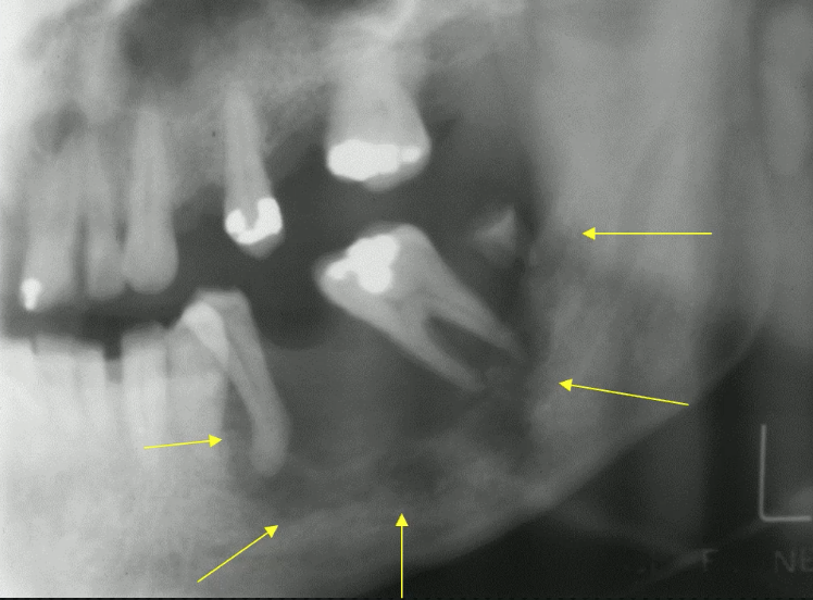 <p>likely cause of these “floating teeth” </p>