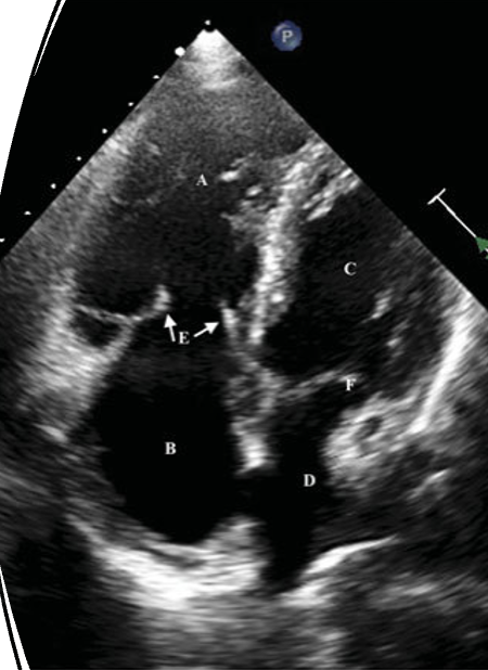 <p><span style="font-family: &quot;Calibri Light&quot;">_______________ occurs when large amounts of vasoactive substances such as serotonin, tachykinins, and prostaglandins reach the right side of the heart, consequent to reduced hepatic metabolism from extensive metastatic liver involvement of the carcinoid tumor.</span></p>