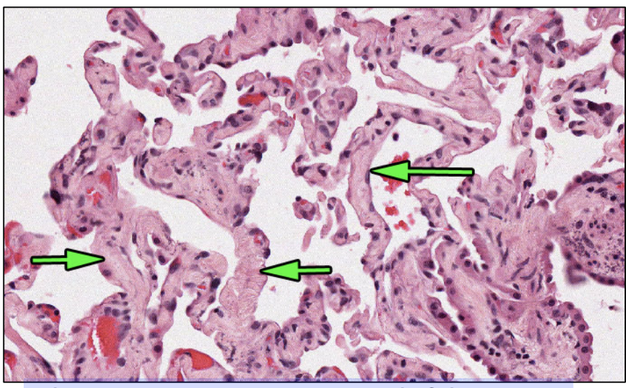fibrosis