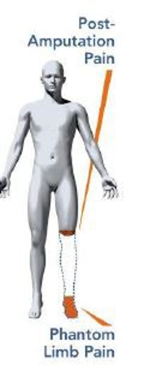 <p>pain or discomfort felt in an amputated limb</p>