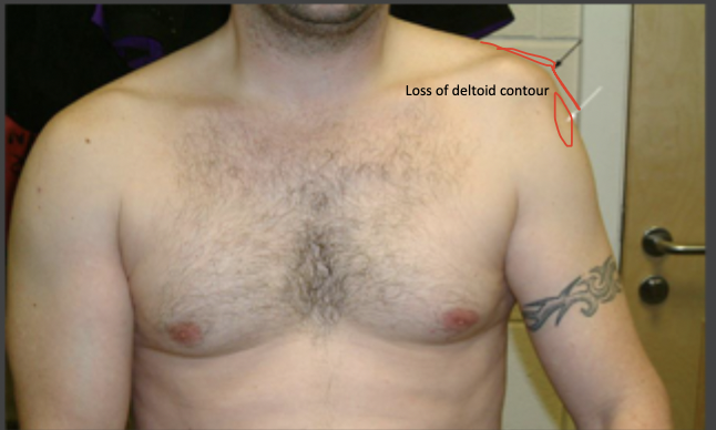<p>Anterior shoulder dislocations (90%) are caused by</p>