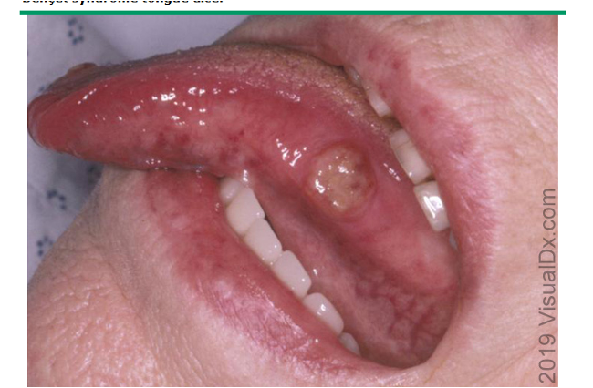 <p>rare vasculitis characterized by recurrent aphthous ulcers of mouth, eyes, skin, GI dz, CNS involvement, and arthritis</p><p>exact cause unknown, linked to genetics and infectious exposure</p>