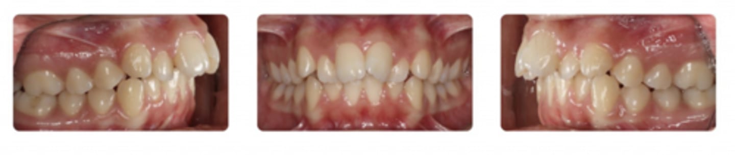 <p>Class II division 1</p>