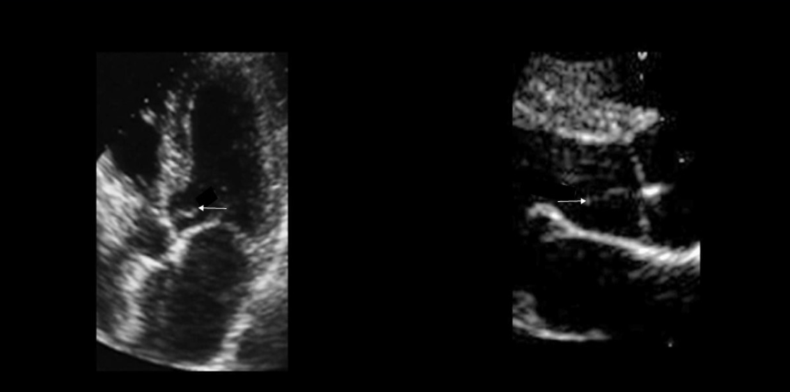 <p>Tiny fibrous strands most commonly form on the aortic valve </p>