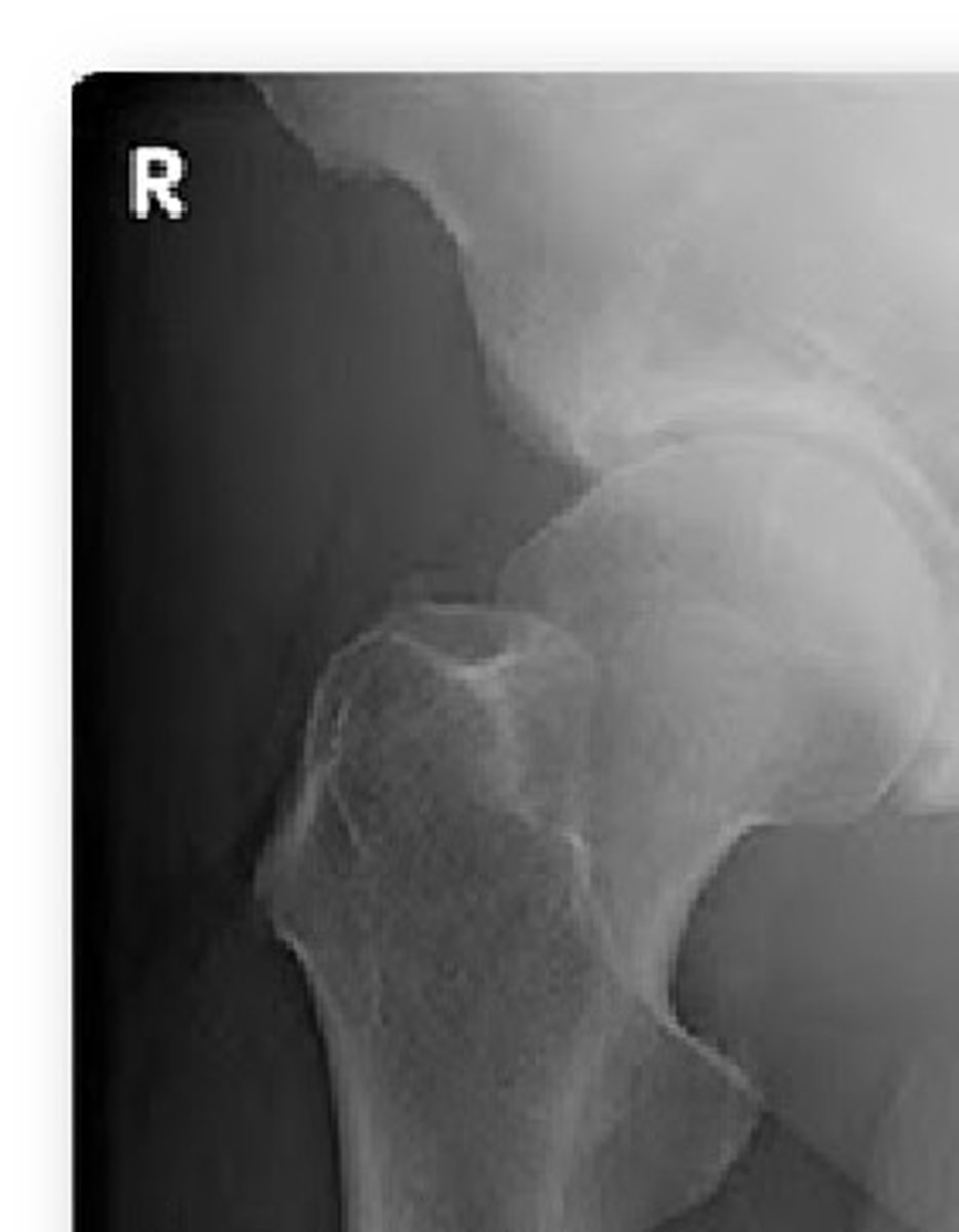 <p>overgrowth of the femoral head/neck</p>