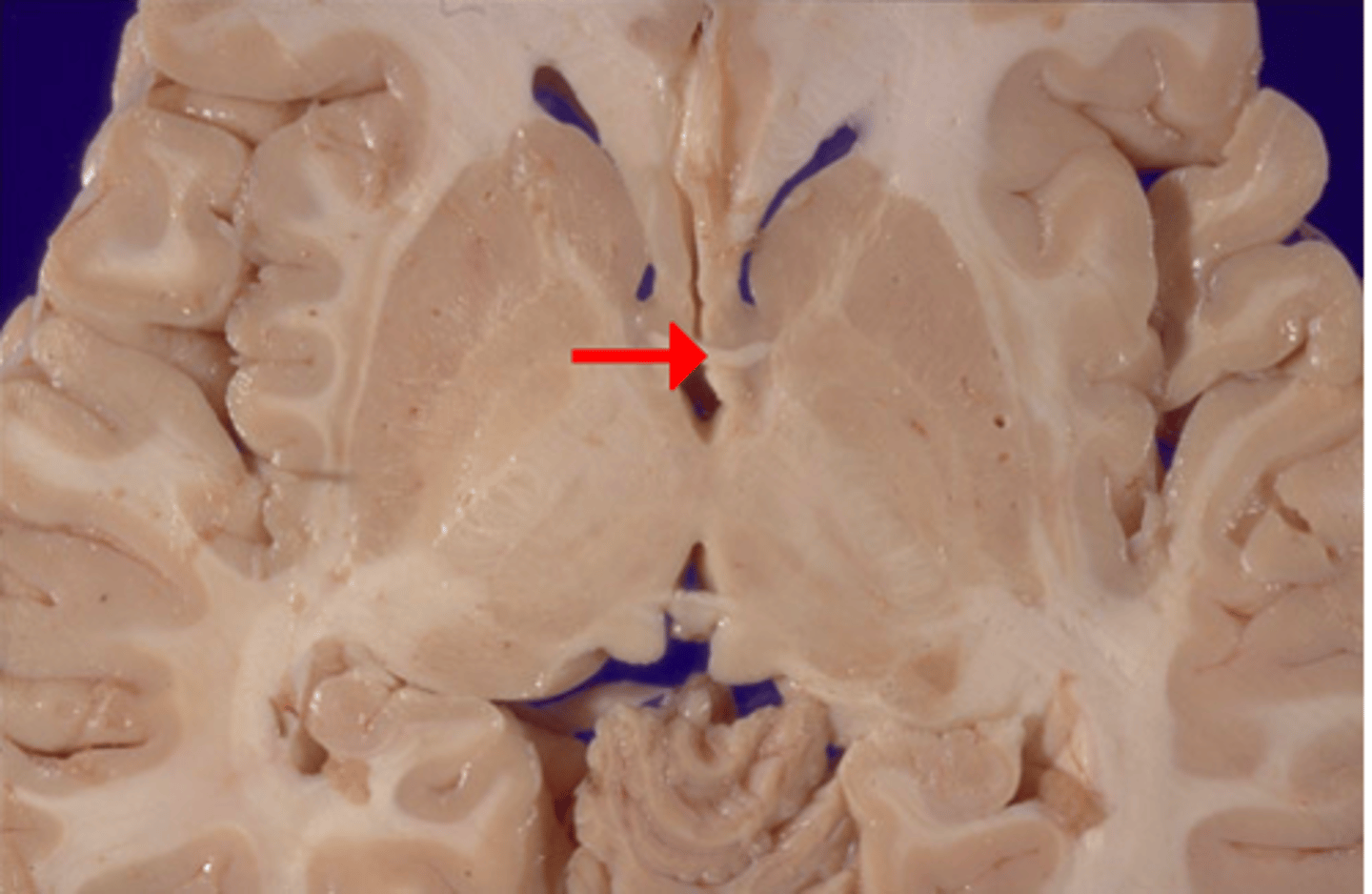 <p>White matter tract that crosses the third ventricle. Located just anterior to the thalamus. connects parts of the frontal+temporal lobes of the 2 hemispheres.</p>