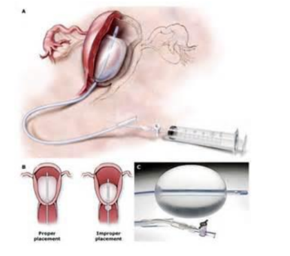 <p>Intrauterine balloon tamponade device used to control postpartum hemorrhage; commonly filled with normal saline (e.g., 500 mL) to apply internal pressure and stop bleeding</p>