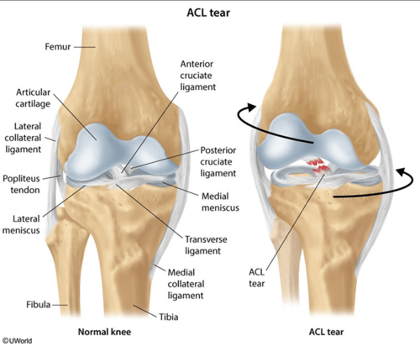 <p>What does the ACL connect?</p><p>- extends from the lateral femoral condyle to the anterior tibia</p><p>- prevents anterior translocation at the knee joint</p><p>What does the PCL connect?</p><p>- extends from the medial femoral condyle to the posterior tibia</p>