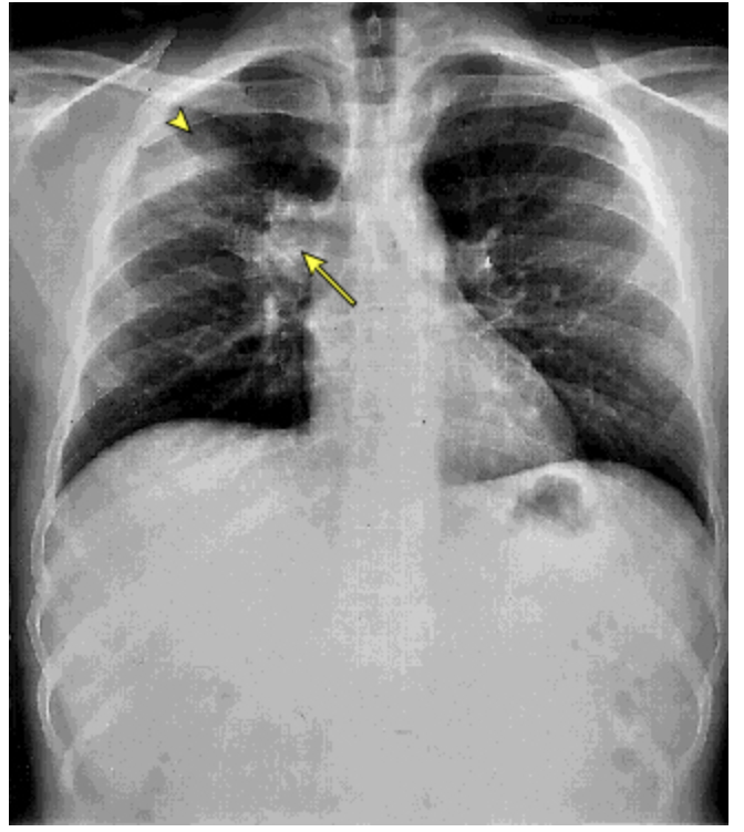 <p>Patient reports to the ER for chest pain and dyspnea. While collecting a history your patient reports that he just got back from a 2 week spelunking vacation. He also reports that he is a transplant patient and is on immunosuppression. He reports night sweats, cough, HA, chills, fever, and muscle pain. CXR shows prominent hilar adenopathy and pulmonary infiltrates. What is your treatment plan?</p>