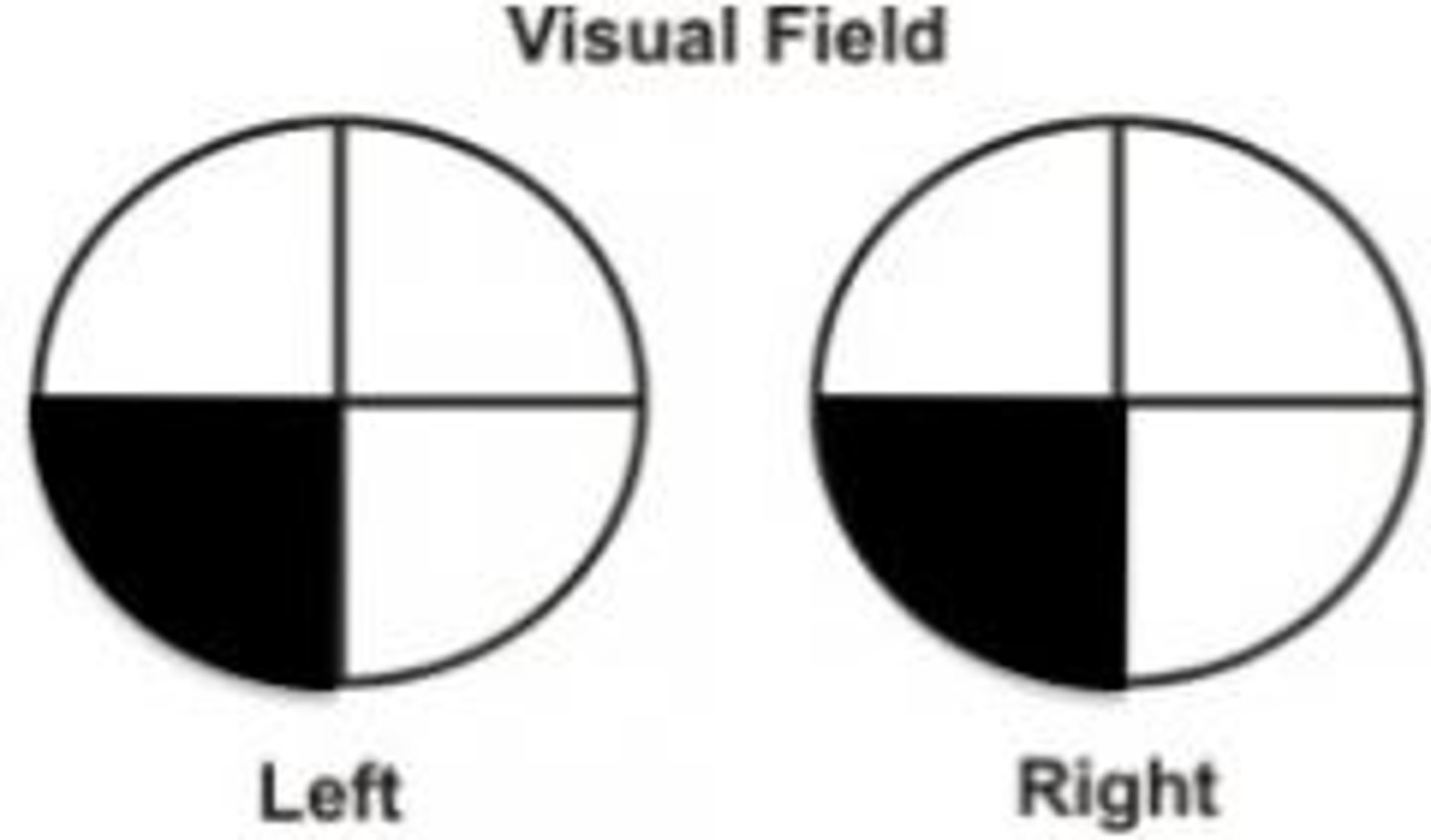 <p>Contralateral (L) inferior quadrantanopia</p>