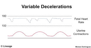 <p><strong>Define variable decelerations</strong></p>