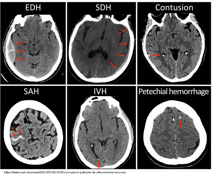 <p>Temporary interruption of brain function from head jarring, with no structural changes. (Plain radiographs do not show the presence of a concussion, although, as mentioned above, patients are often sent for a CT to rule out any other pathologies which can have similar symptoms)</p>
