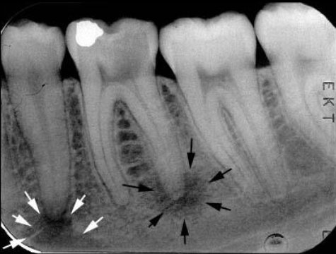 <p>What is the bony landmark that the white arrows are pointing to? </p>