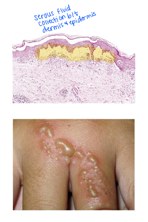 <p>Which morphologic pattern exemplifies:</p><ul><li><p>accumulation of serum-like protein-rich exudates</p></li><li><p>skin blistering (burn/viral infection) - accumulation of serous fluid or beneath damaged epidermis</p></li></ul><p></p>