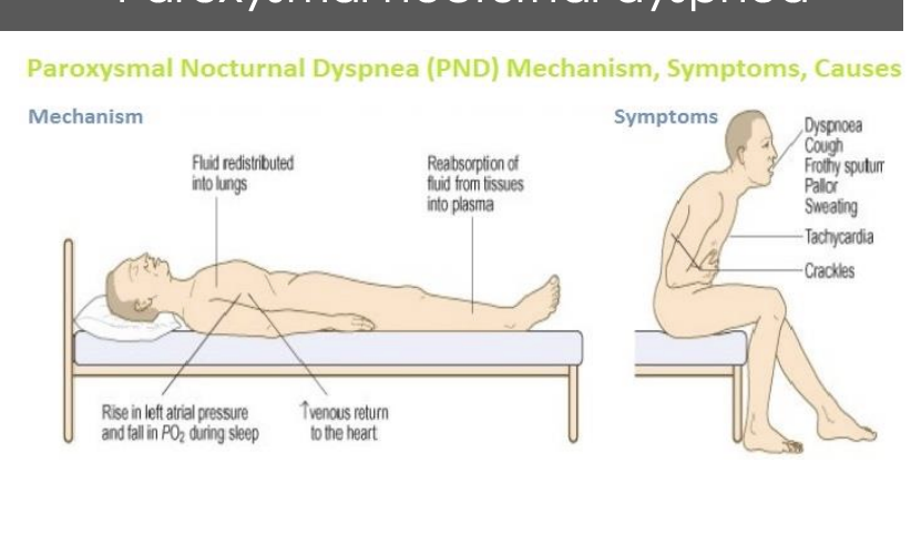 <p>definitions: <span><span>chronic condition where the heart muscle weakens and can't pump enough blood to meet the body's needs, causing blood and fluid to back up (congestion) in the lungs</span></span></p><p></p><p>signs: </p><ol><li><p><strong>Dyspnea (exertional → resting):</strong><br>Shortness of breath caused by fluid congestion in the lungs; it first appears during physical activity and, as congestion worsens, occurs even at rest.</p></li><li><p><strong>Orthopnea:</strong><br>Shortness of breath when lying flat due to increased venous return and pulmonary congestion; relieved by sitting up or using multiple pillows.</p></li><li><p><strong>Cough:</strong><br>Often a dry or frothy cough caused by pulmonary congestion and fluid accumulation irritating the airways.</p></li><li><p><strong>Peripheral edema (pitting edema):</strong><br>Swelling of the lower extremities due to venous congestion and fluid retention; pressing on the swollen area leaves a temporary indentation.</p></li><li><p><strong>Paroxysmal nocturnal dyspnea (PND):</strong><br>Sudden episodes of severe shortness of breath at night caused by redistribution of fluid to the lungs during sleep, forcing the person to wake up gasping for air.</p></li></ol><p></p>