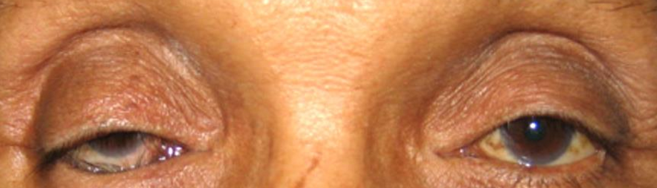 <p>What eyelid position condition is this?</p>