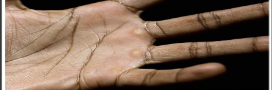 <p>Thickened, elevated pad on the dermis caused by repetitive rubbing.</p>