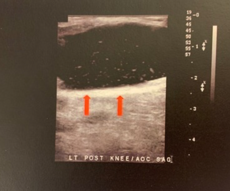 <p>What artifact is demonstrated on the US image by the red arrows?</p><p>a. reverberation<br>b. posterior enhancement <br>c. dirty posterior shadowing<br>d. defocusing</p>