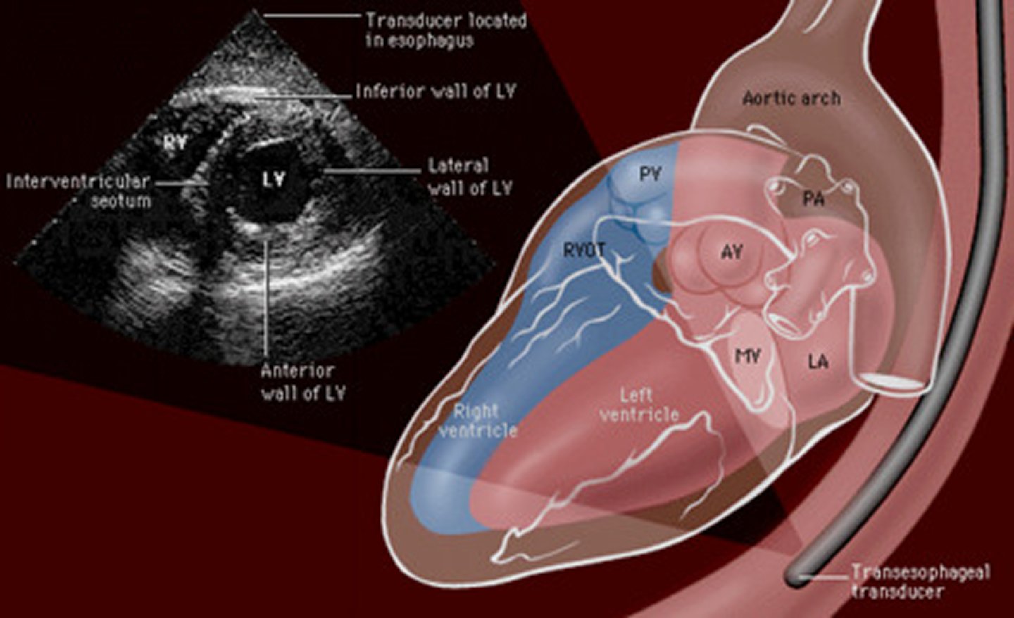 <p>- EKG wide QRS</p><p>- CXR</p><p>- echo</p><p>- transesophageal echo (TEE)*** </p><p>- cardiac catheterization/ arteriography</p><p>- ventriculogram</p>