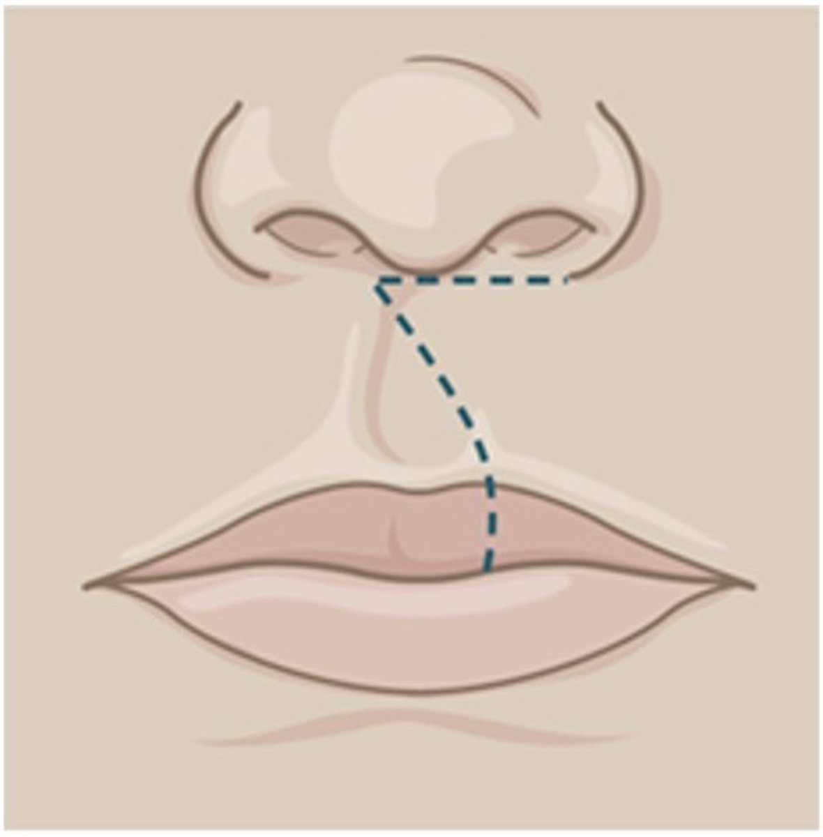 <p>.... closure is the most common type of cleft lip closure</p>