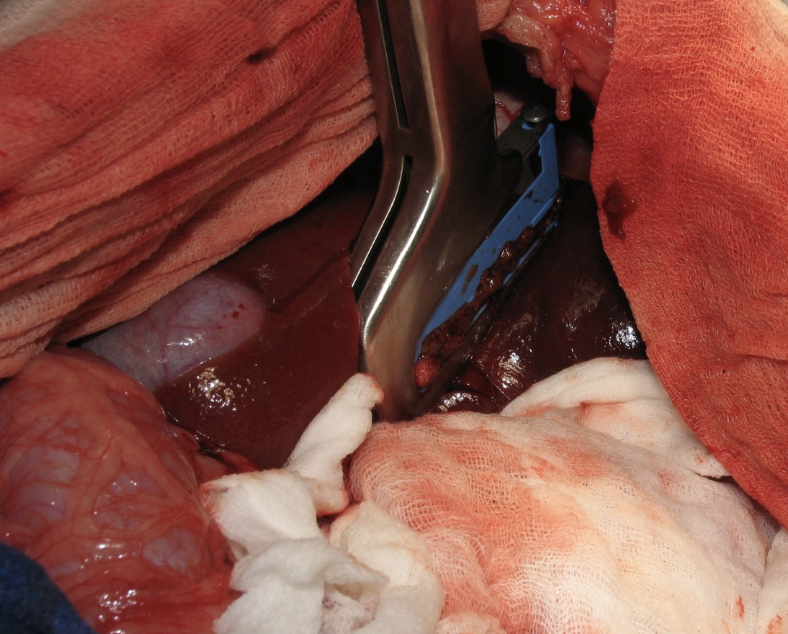 <p>- Liver capsule transected, blunt dissection to ID large vessels</p><p>- Stapling devices</p><p>- Vessel sealant devices</p><p></p><p>Complete:</p><ul><li><p>stapling devices</p></li><li><p>blunt dissection and suture ligation</p></li></ul><p></p>