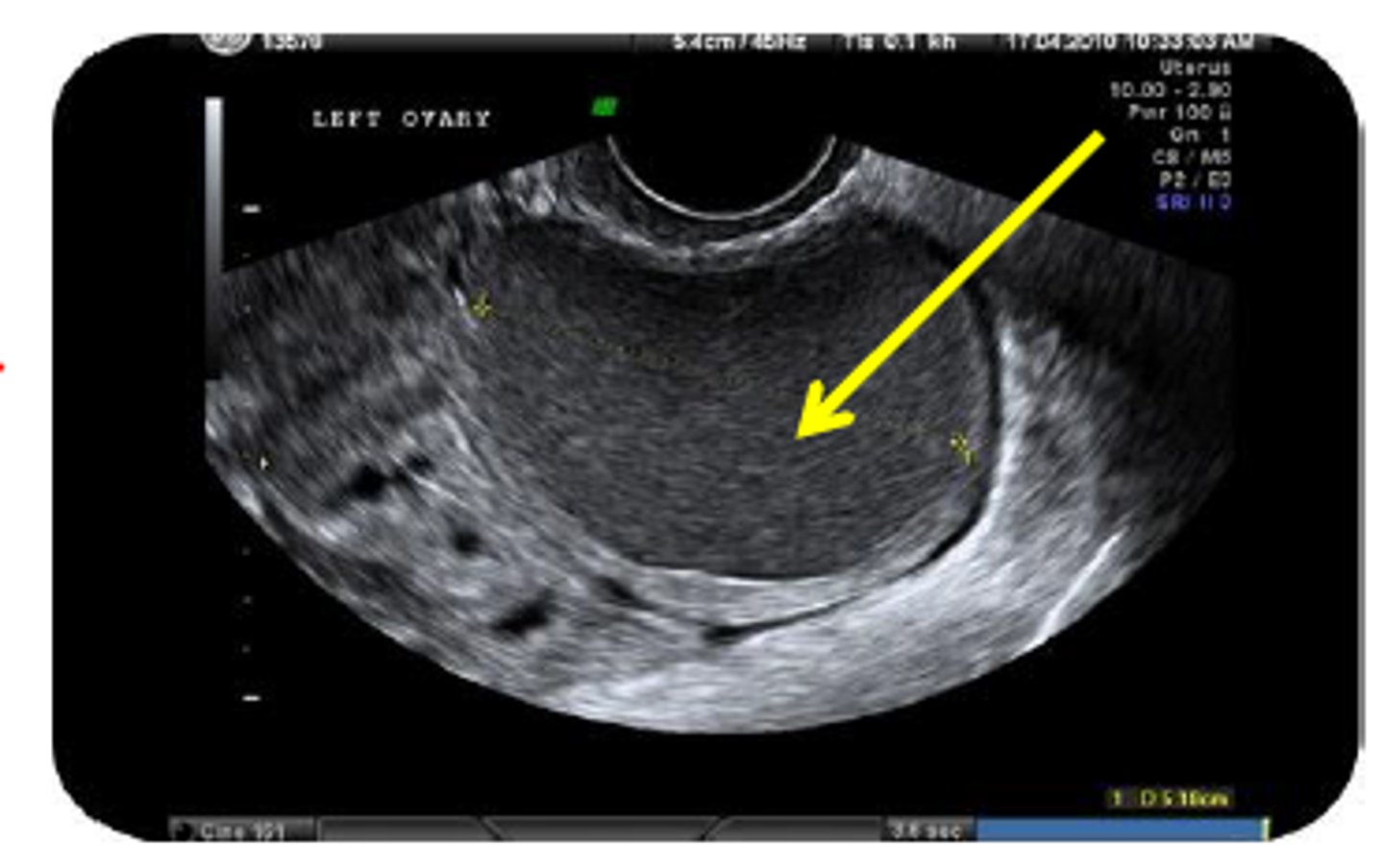 <p>Endometrioma</p>