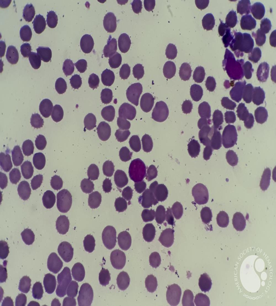 <p><span>Spherocytes</span></p>