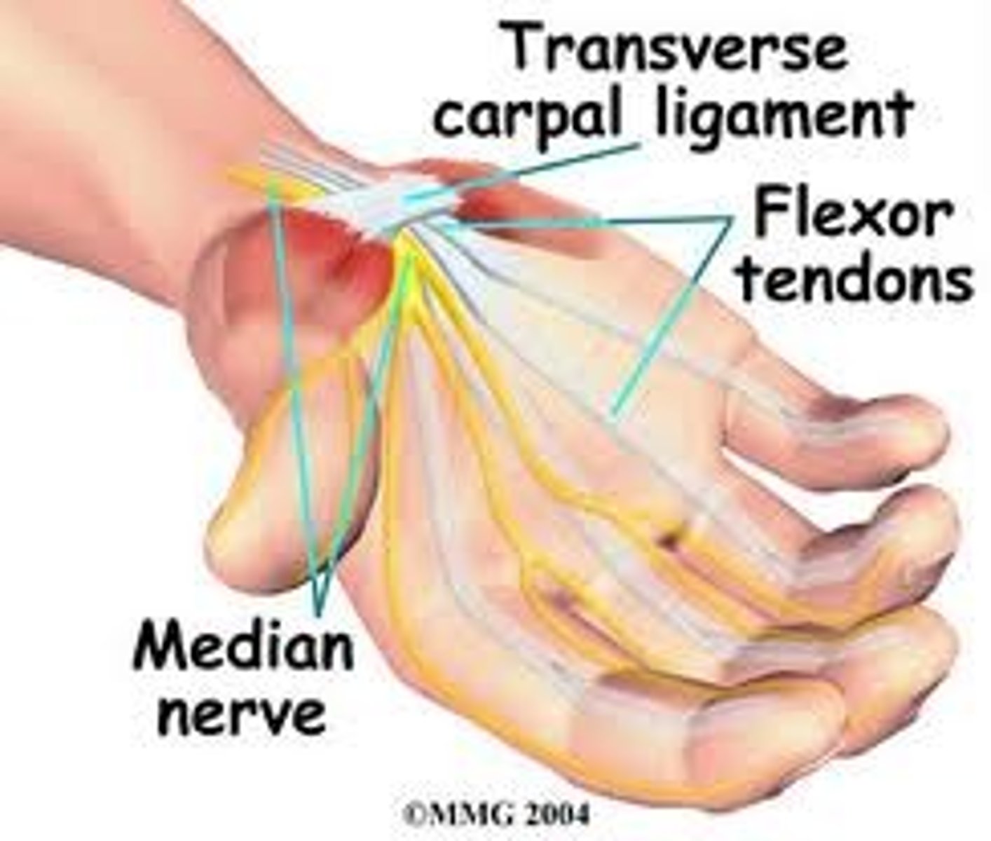 <p>a passageway that runs from the forearm through the wrist</p><p>Consists of: flexor digitorum superficialis tendons, flexor digitorum profundus tendons, flexor pollicis longus tendon, median nerve</p><p>Borders: roof: flexor retinaculum. floor: carpal bones</p>