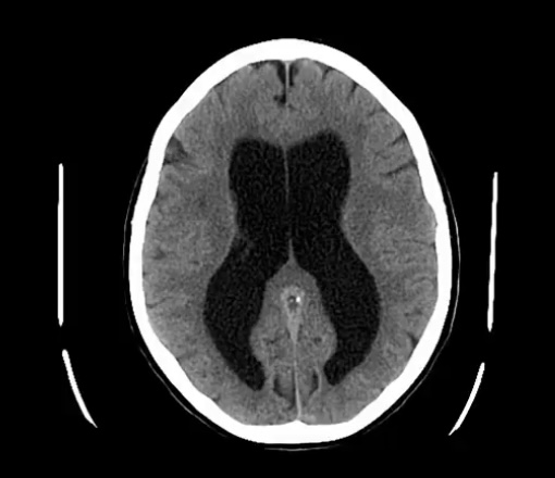<p>-ventricles; CSF</p><p>COMMUNICATING HYDROCEPHALUS…</p><p>-ventricles</p><p>-CSF absorption; arachnoid villi; ICP</p><p>-papilledema of eyes</p><p>-dilation of ALL ventricles</p><p>-meningitis; scarring</p><p>NON-CUMMUNICATING HYDROCEPHALUS…</p><p>-ventricles</p><p>-structural blockage</p><p>-congenital; aqueductal stenosis, chiari malformations, and dandy walker malformations</p>