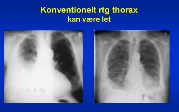 \-Er alltid en komplikation til pneumoni (så pt har haft en pneumoni eller har en pneumoni som ikke forsvinder på antibiotika fx)

\-feber, vedvarende/sekundær pneumoni,nedsat AT, evt stingsmerter i bryst og dyspnø

\
Røntgen:

\-Hvid opklaring som følger pleuras form (stående rtg: nederst og op lateralt - i modsætning til pleuraeffusion som er fri væske og ikke følger pleuras form så nøje)

\-Afkapslet, halvkugleformet infiltrat som er hvidt