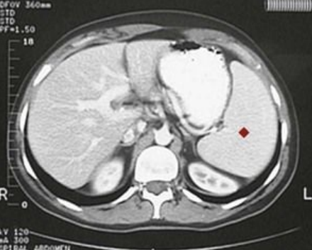 <p>8.5 Side B (PBD9: 360; BP9: 426)<br></p>
<p><br></p>
<p>Questions<br></p>
<p>A 17-year-old boy with fever and lymphadenopathy has a positive Monospot test. CT shows splenomegaly.<br></p>
<p><br></p>
<p>1. What is the explanation for the left upper quadrant pain?<br></p>
<p>2. What is the possible long-term complication of an EBV infection?<br></p>