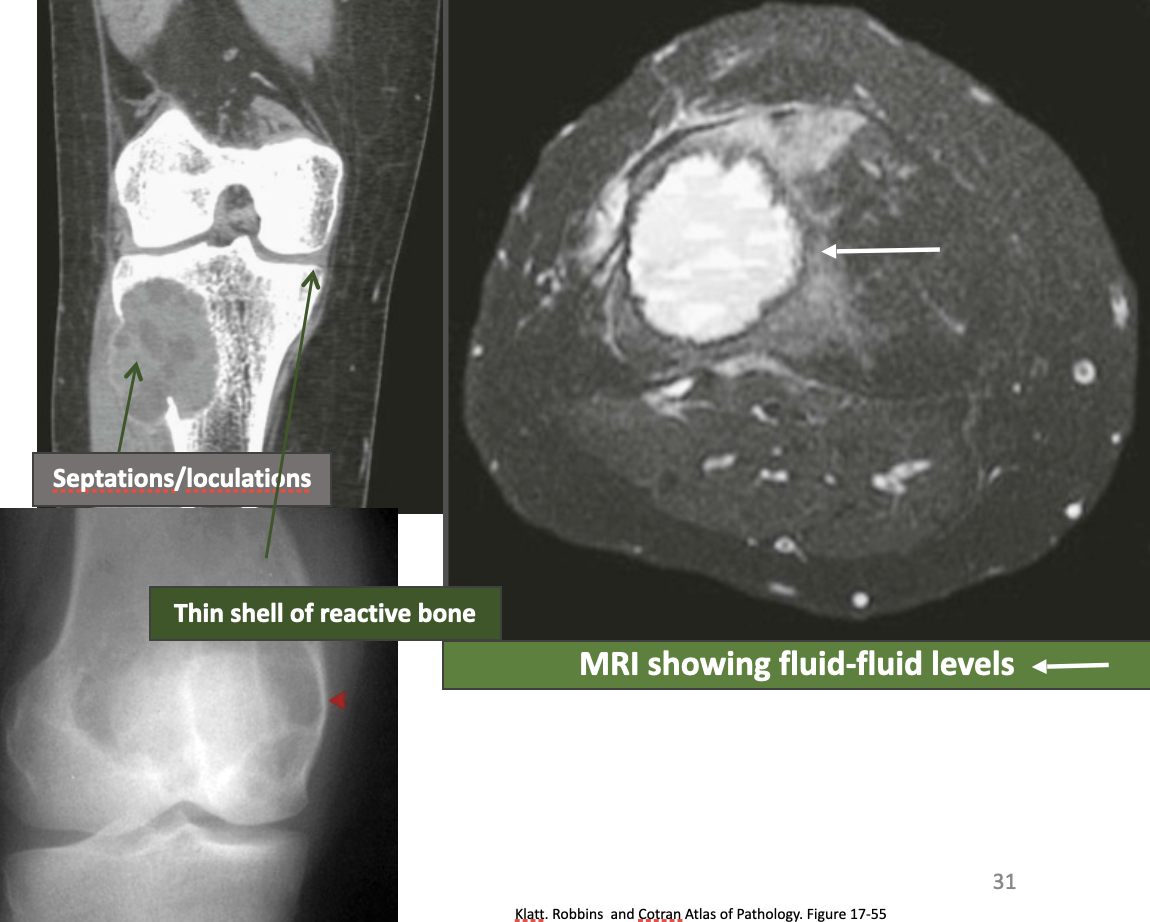 <p>What disease is this showing?</p>