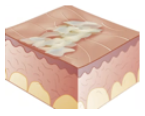 <p>Secondary Skin Lesion</p><ul><li><p>Portion of <strong>dead skin</strong> or <strong>desquamation</strong> of epidermis</p></li><li><p>E.g., psoriasis</p></li></ul><p></p>