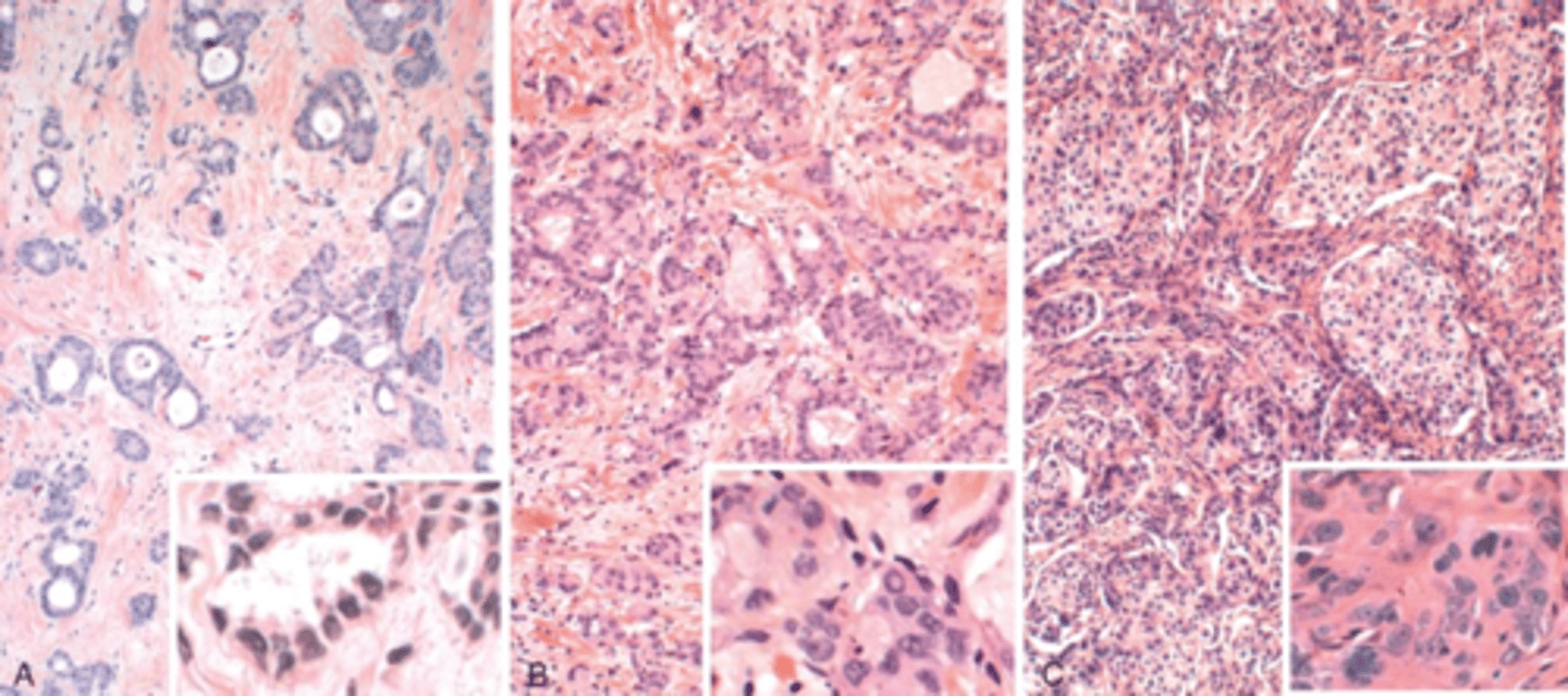 <p>1. Tubule formation 2. Nuclear pleomorphism 3. Mitotic count</p>