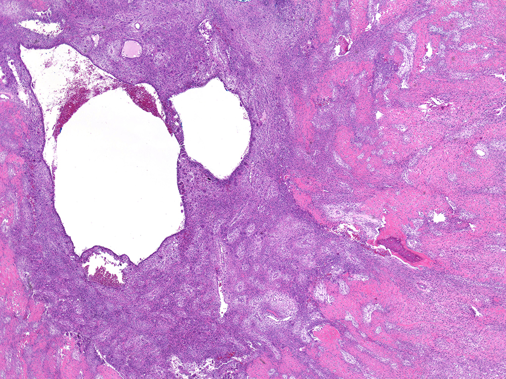 <p>Lésion ulna jeune patient après trauma</p><p>1) Diagnostic&nbsp;</p><p>2) Epidemio (type de patient, localisation, histoire typique)</p><p>3) Histo&nbsp;</p><p>4) Moléculaire&nbsp;</p>