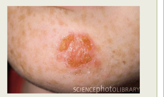 What infection is this?