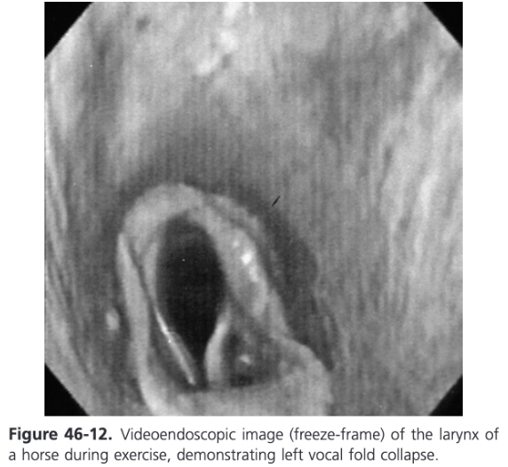 <ul><li><p><span>Can only be observed during high-speed exercise using videoendoscopy</span></p></li><li><p><span>Stabilization of the vocal cord occurs when the cricothyroid muscle, which is innervated by a branch of the cranial laryngeal nerve, contracts</span></p></li><li><p><span>Occasionally, medial deviation of the fold occurs in horses with resting laryngeal grade 3 RLN</span></p></li><li><p><span>Observed after laryngoplasty when only a concurrent VC has been performed</span></p></li><li><p><span>Treatment is bilateral ventriculocordectomy</span></p></li></ul>