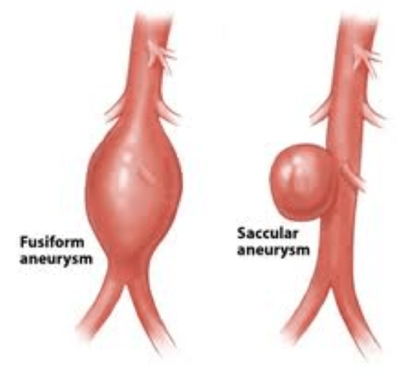 <p>- fusiform - bulges on all sides of the blood vessel</p><p>- saccular - bulges on one side</p>