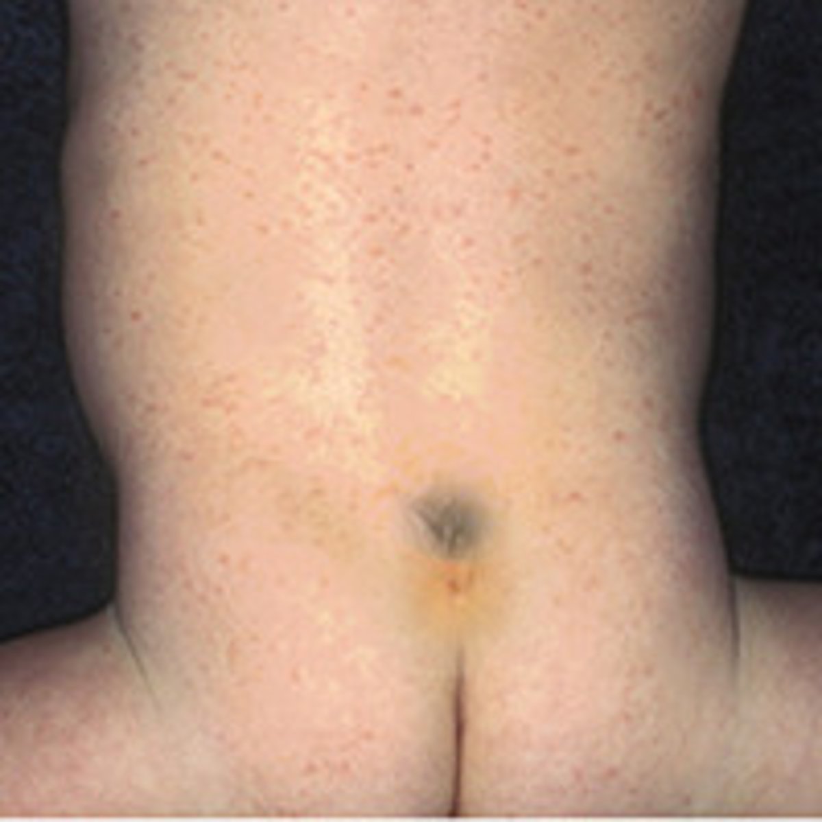 <p>Hair on lower lumbar region</p>