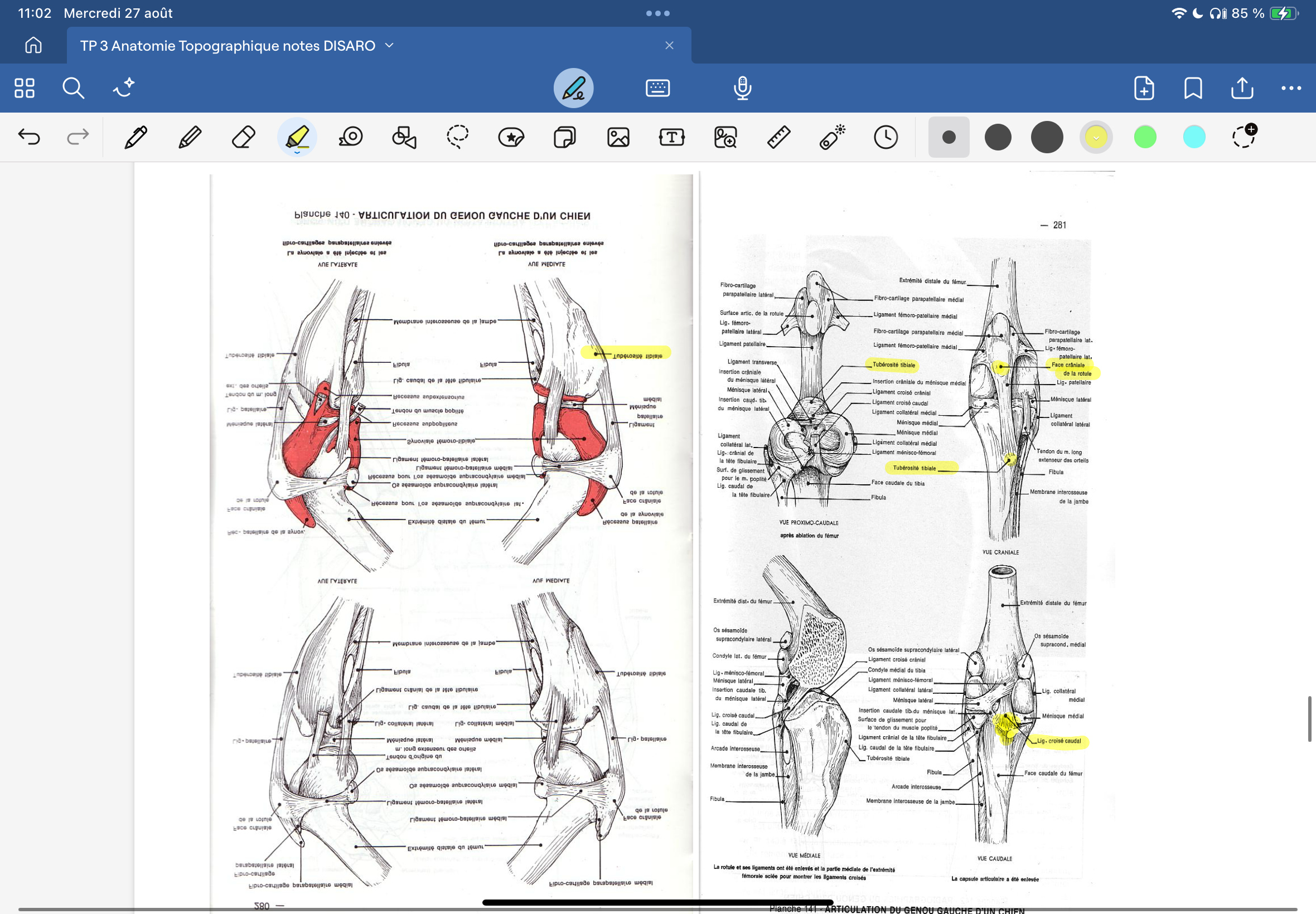 <p>Lésions méniscales lors d’instabilité du genou: le ménisque latéral n’est pas adhérent au ligament collatéral comme le médial à cause du passage du tendon du muscle pectiné et est attaché caudalement par le ligament ménisco fémoral. Lors d’instabilité du genou (lors de RLCA), le ménisque médial accompagne le glissement du plateau tibial vers l’avant et peut donc être lésé.</p>
