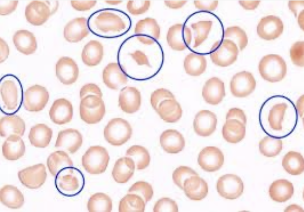 <p>What type of smear cell and what conditions is it seen in</p>