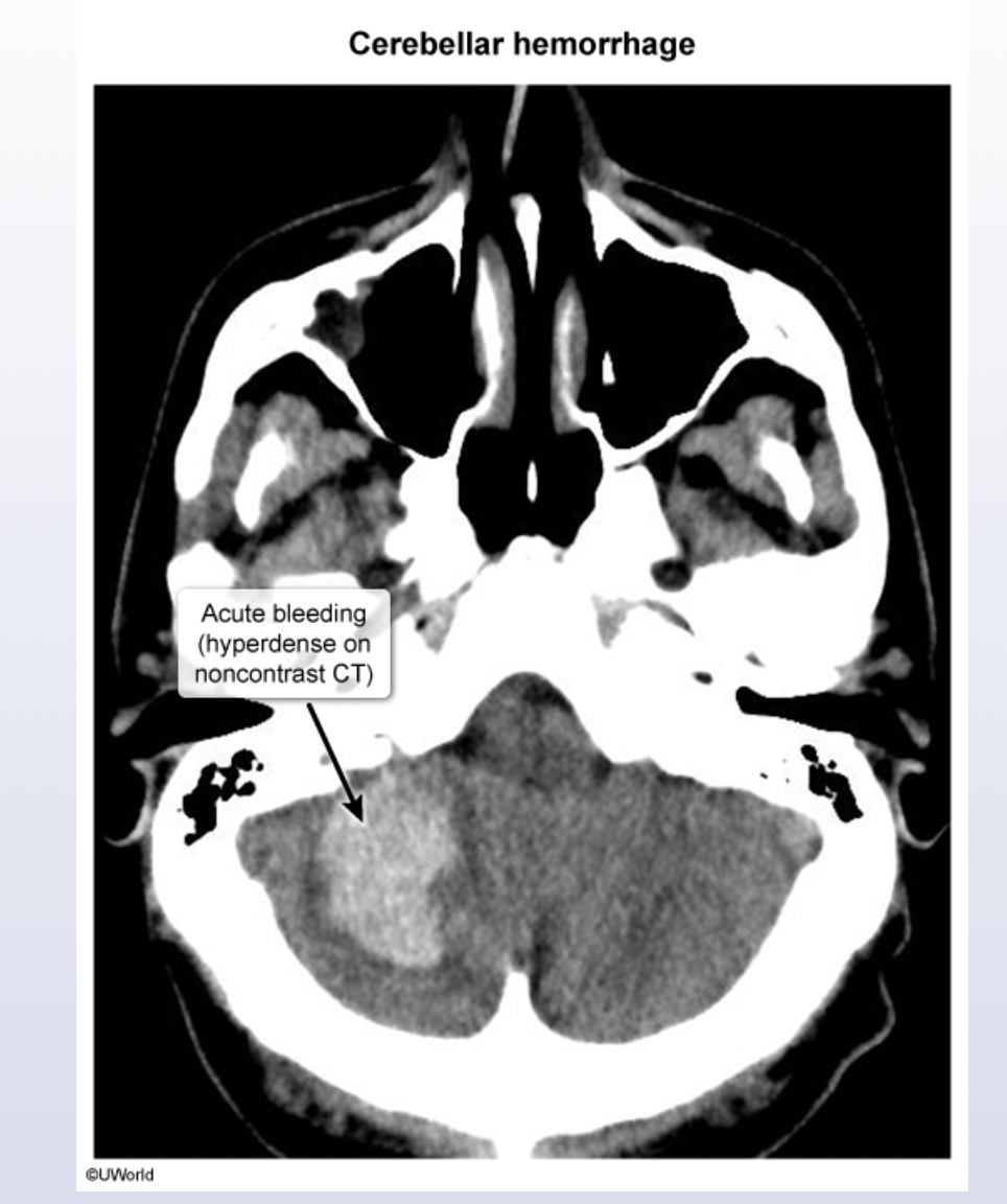 <p>Intra-parenchymal Brain Bleed of the Cerebellar Region</p>