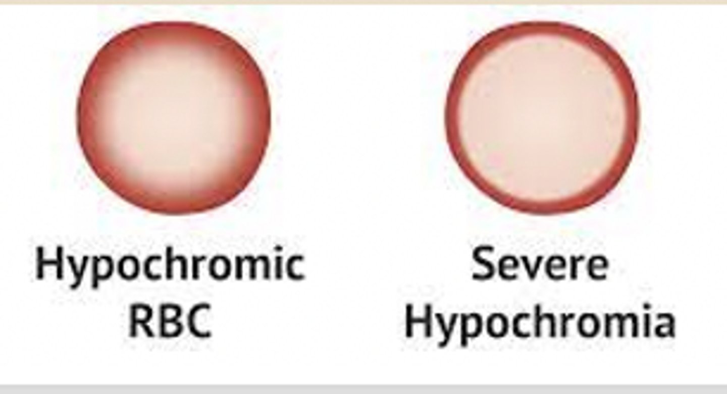 <p>what are two examples of hypochromic anemia?</p>