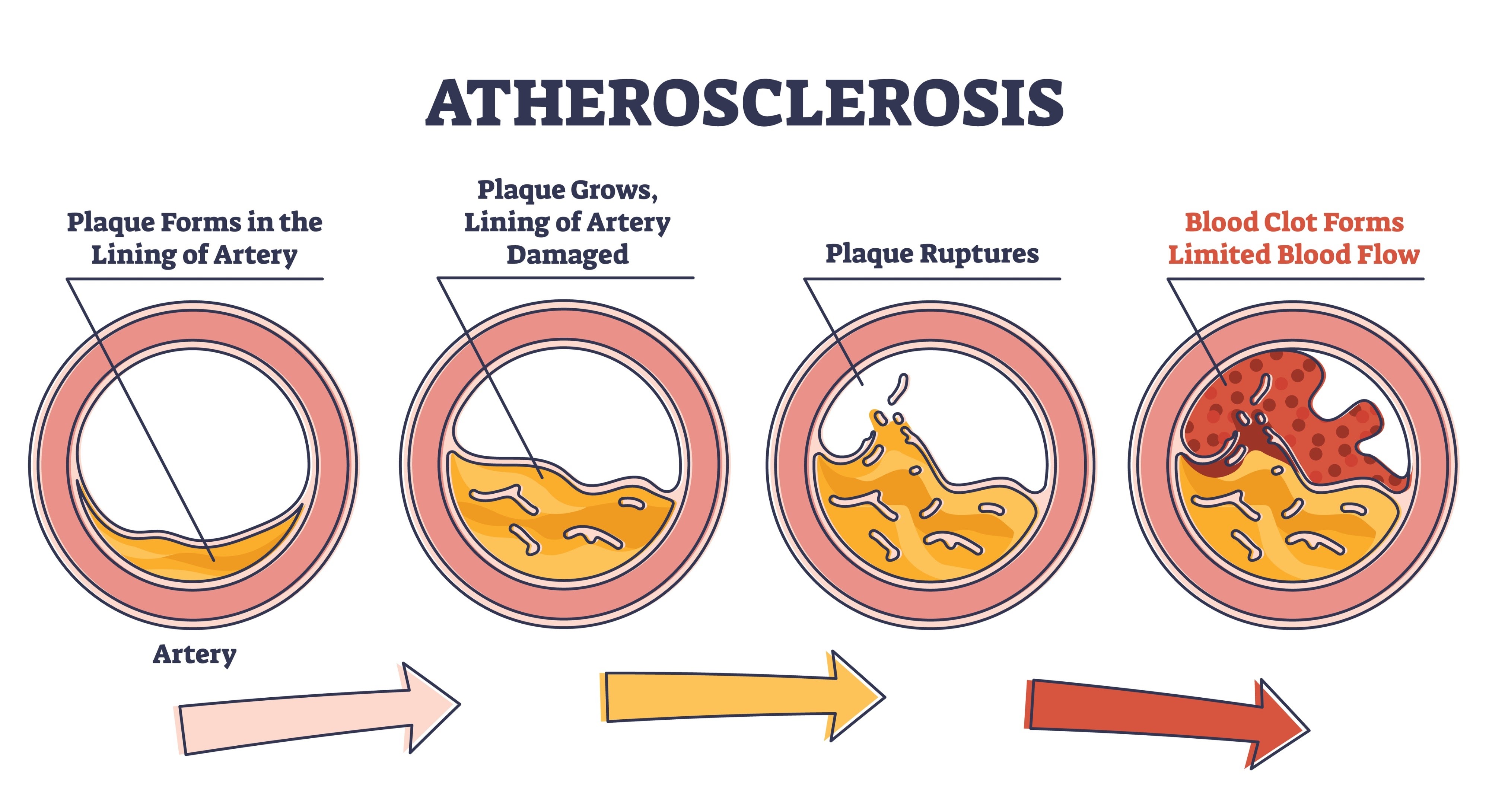 <ul><li><p>It is the progressive thickening and narrowing of an artery wall due to the accumulation of fatty substances, such as high cholesterol, smoking, and high blood sugar. </p></li><li><p>Atherosclerosis is the leading cause of many diseases, like cardiac arrest, stroke,and&nbsp; peripheral vascular disease&nbsp;</p></li></ul><p></p>