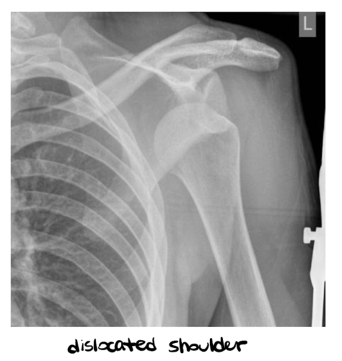 <p>- Dislocation</p><p>- Subluxation</p>