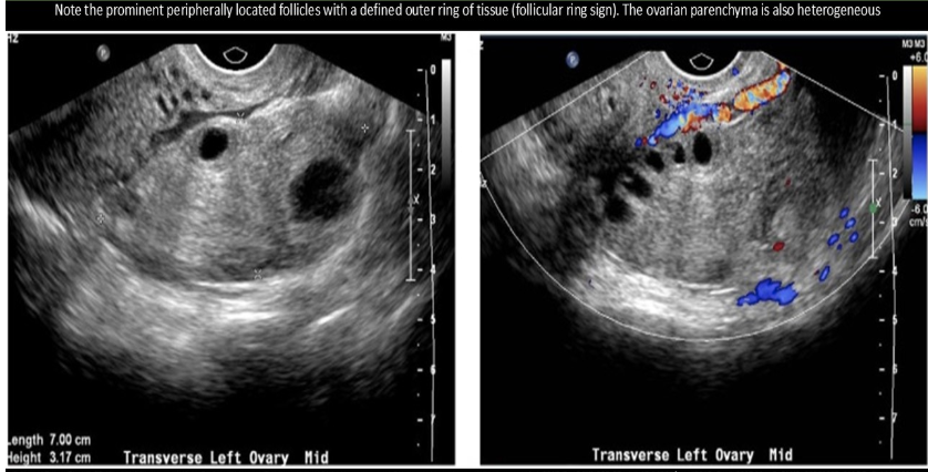 <p>the follicular ring sign is assoc w/</p><p>a) ectopic pregnancy</p><p>b) OHS</p><p>c) ovarian torsion</p><p>d) normal intrauterine pregnancy </p>